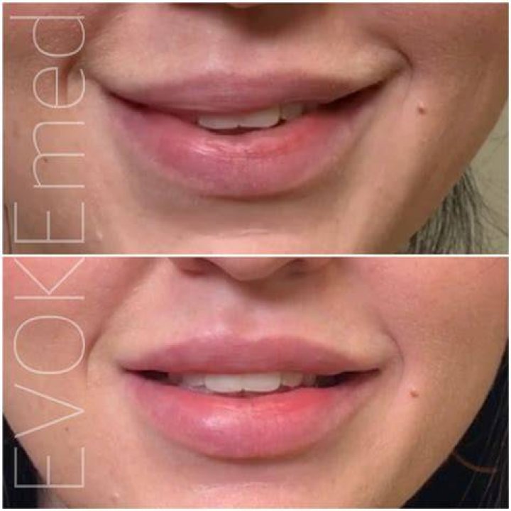 Botched Filler Correction Gallery &mdash; EVOKE AESTHETICS