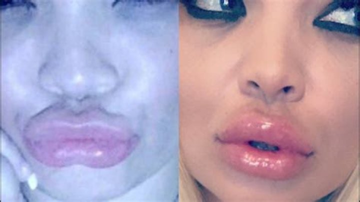 BOTCHED LIPS HAVING MY LIP FILLER DISSOLVED, THE PROCEDURE, BEFORE
