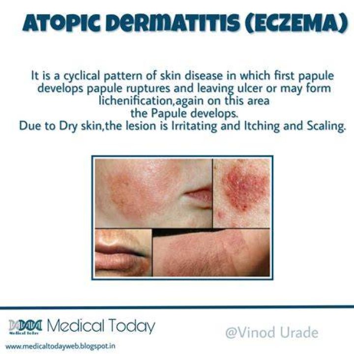 Eczema (Atopic Dermatitis) Complications Christ Memorial