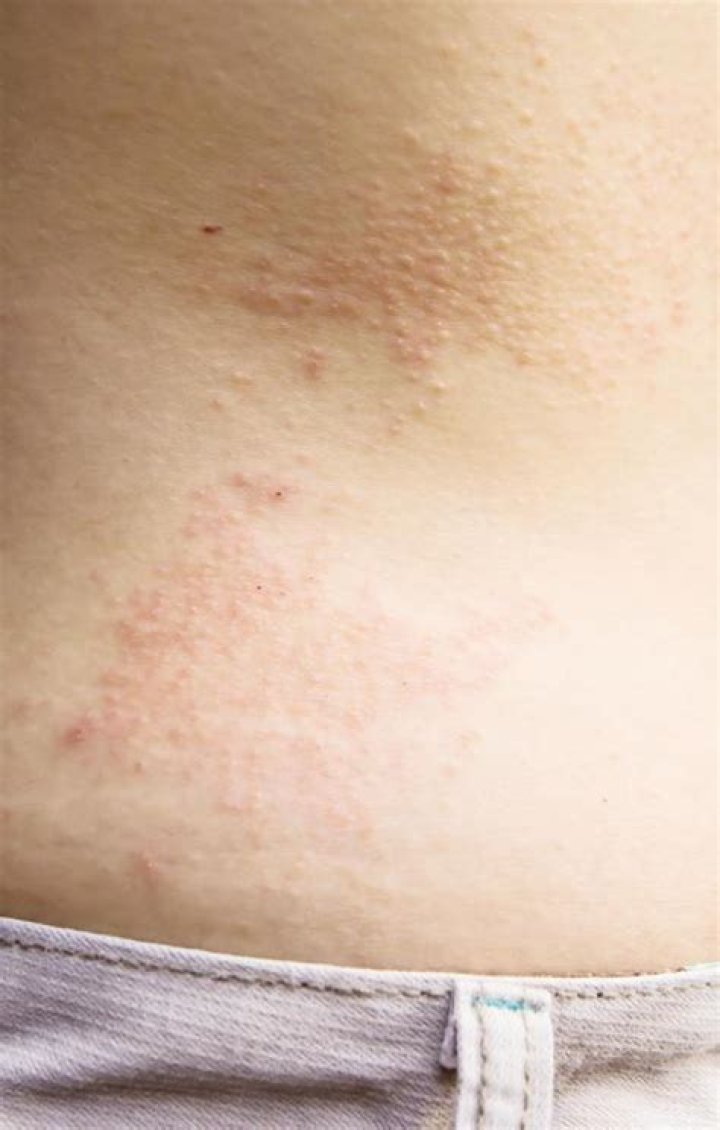 Eczema Type Rash On Breast Design Talk