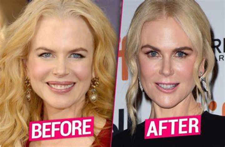 Nicole Kidman Sparks Plastic Surgery Rumors With Noticeably Swollen Face!