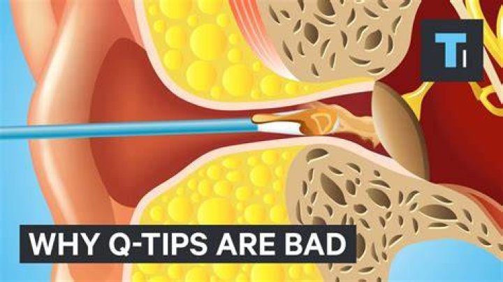 The Dangers of Using QTips for Earwax